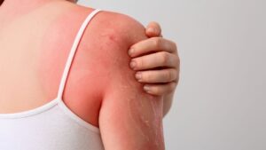 Neoviderm: perché può servire durante le vacanze estive